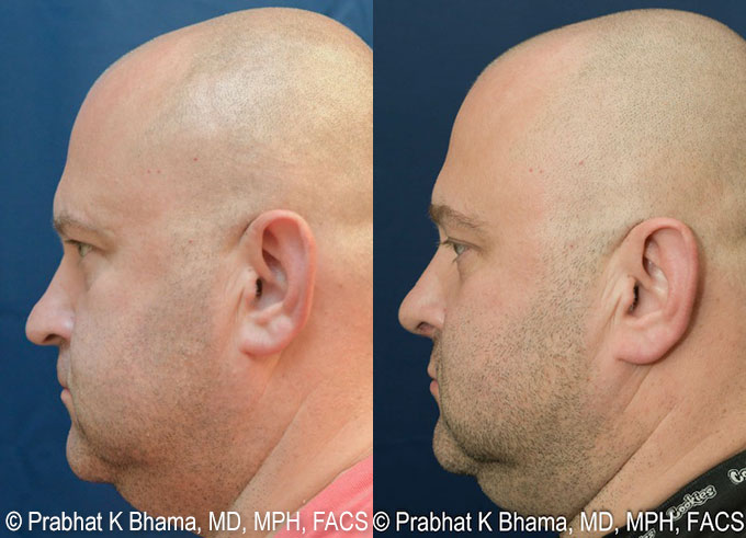 Rhinoplasty Recovery