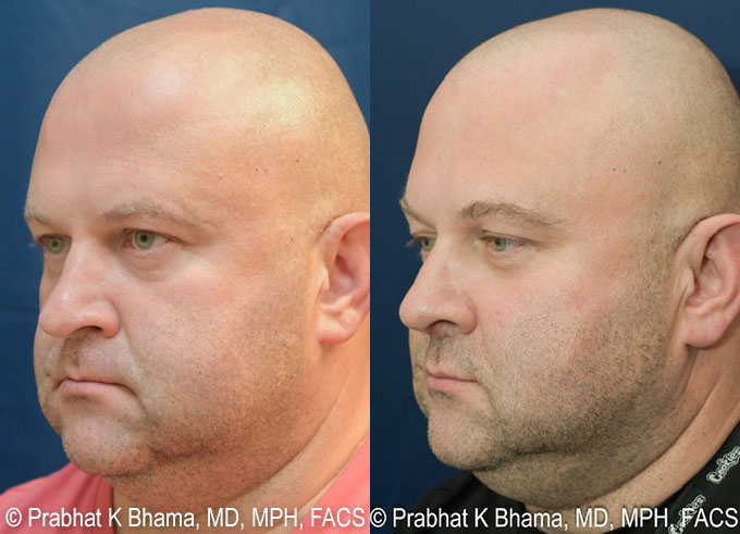 Rhinoplasty Recovery