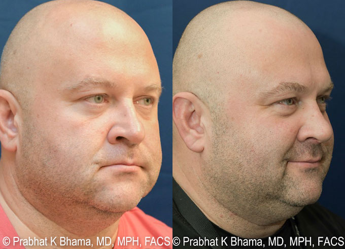 Rhinoplasty Recovery