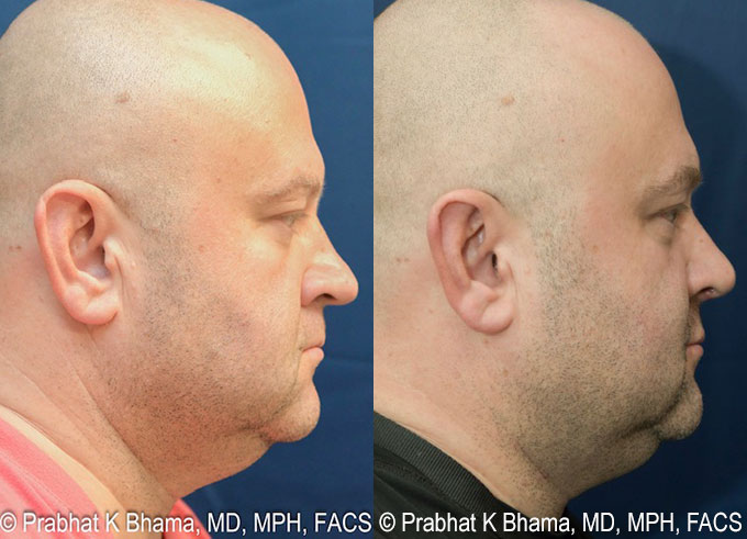 Rhinoplasty Recovery